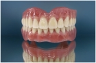 Полное протезирование зубов