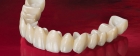 Протезирование зубов циркониевой коронкой