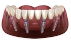 Протезирование зубов на 4-х имплантах