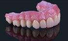 Протезирование зубов нейлоновым протезом