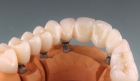 Протезирование зуба на импланте циркониевой коронкой