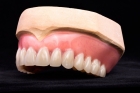 Съемный верхний зубной протез