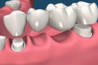 Мостовидный протез зубов
