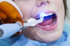 Пломбирование зуба светоотверждаемой пломбой