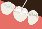 Пломбирование трехканального зуба